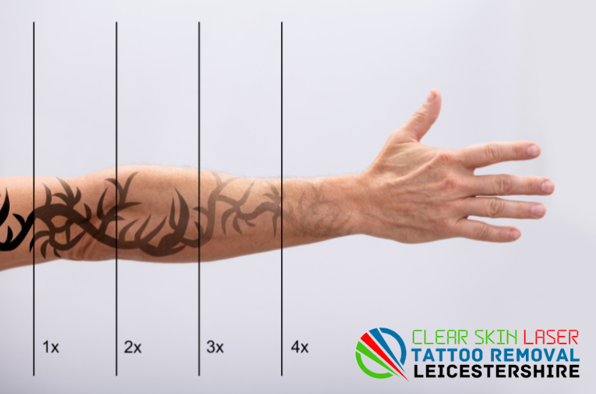 tattoo removal leicester