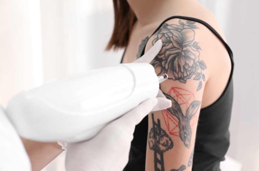 tattoo removal leicester