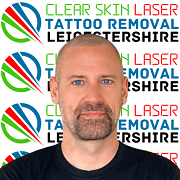 tattoo removal leicester